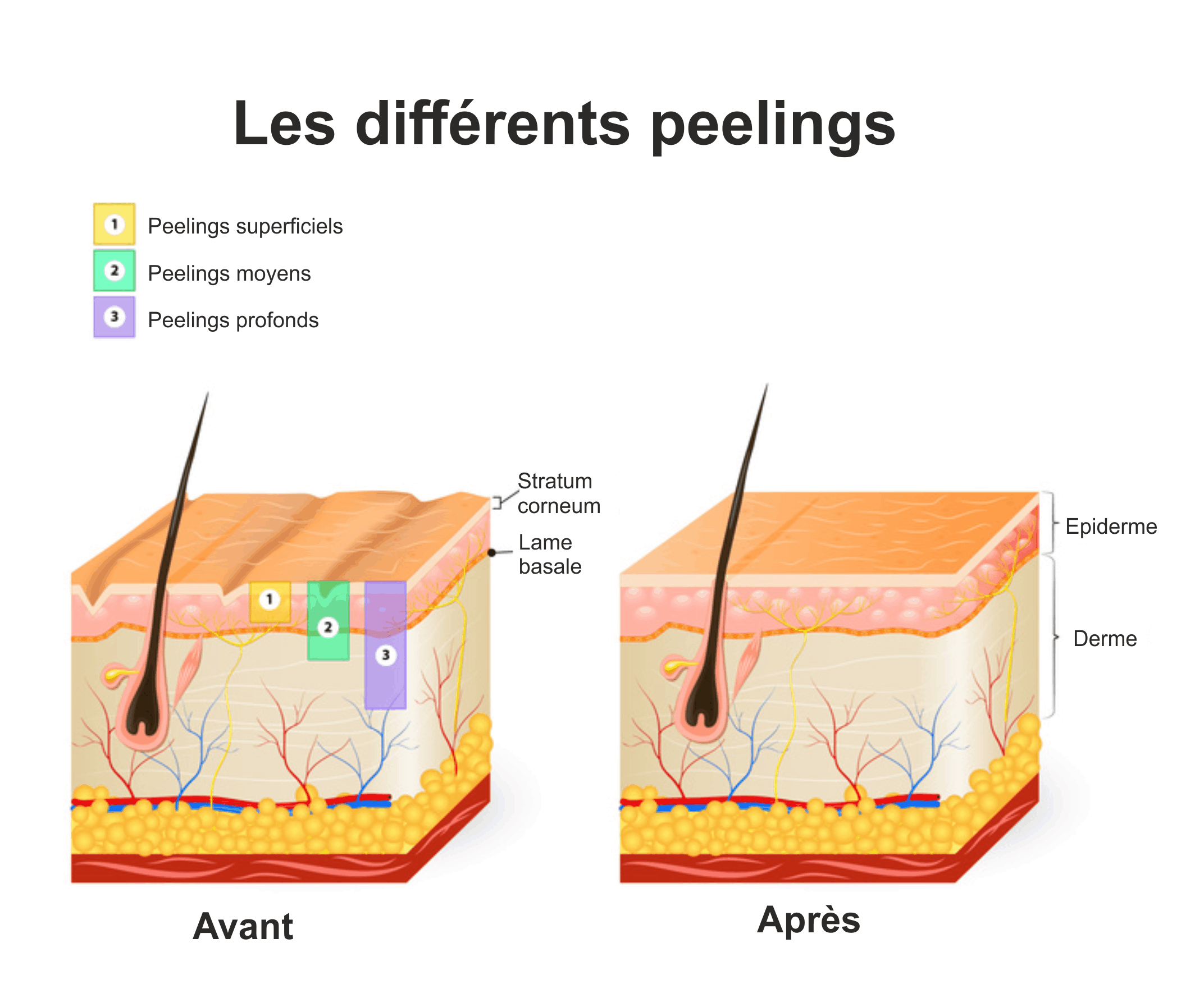 Peelings Nîmes Dr Rocco Medecin esthétique Médecine Anti